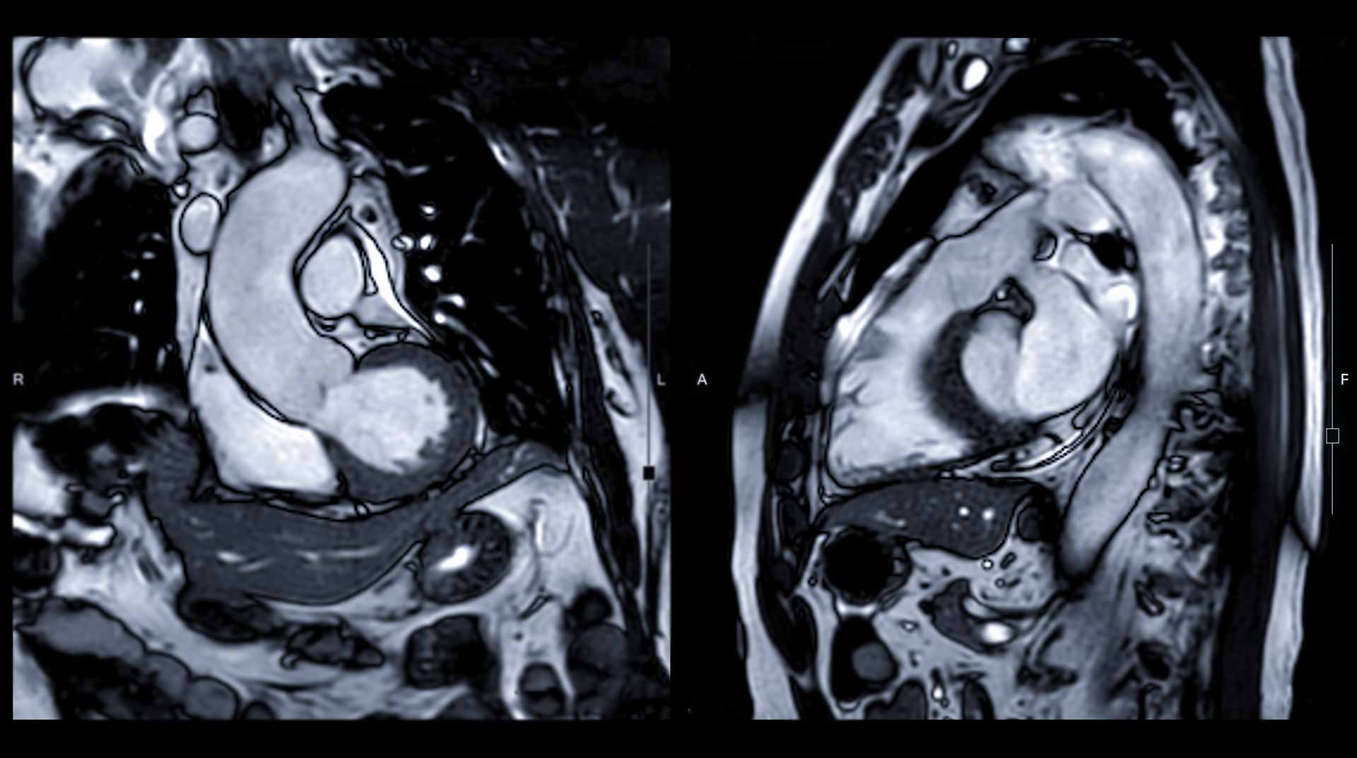 This cross-sectional cardiac MRI image displays detailed heart anatomy, highlighting the heart's structure and blood vessels without the use of ionizing radiation. The image is produced using magnetic resonance imaging technology, which utilizes a strong magnetic field and radio waves to create high-quality images of soft tissues.